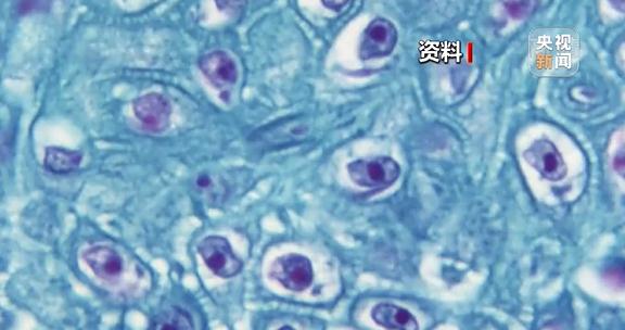 猴痘人际传播途径有哪些？世卫组织预警猴痘病毒将进一步传播